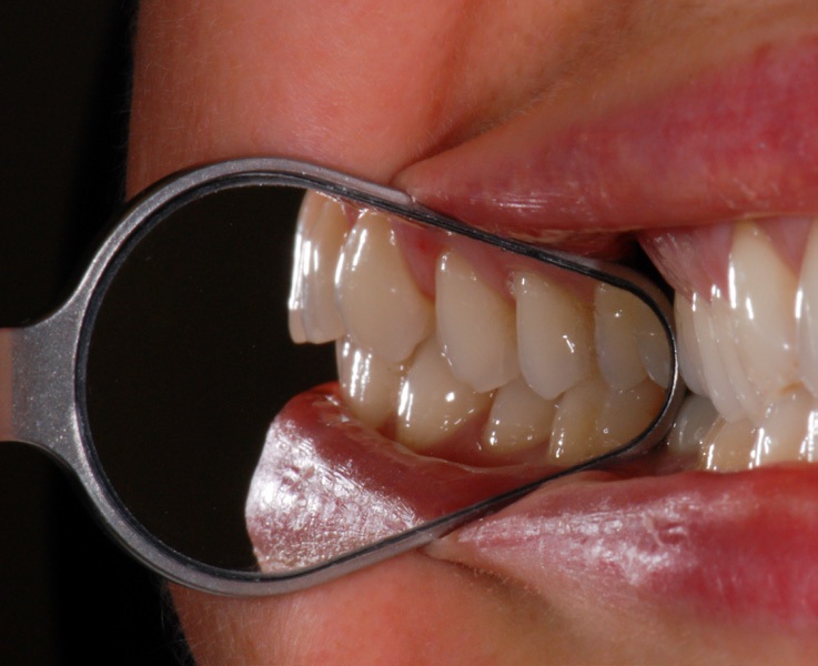 Medesy dentálne zrkladlo v tvare zuba