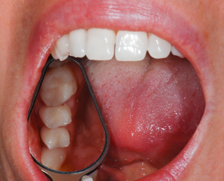 Medesy dentálne zrkladlo v tvare zuba