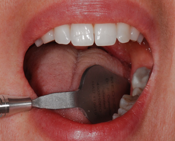 Medesy dentálne zrkladlo v tvare zuba