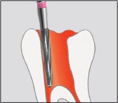 Edenta H152 - endodontické nástroje, extra dlhý kónus Endobur - 5 ks