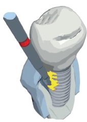 Edenta C560 - chirurgický karbidový nástroj, ošetrenie Peri-Implantitídy - 3 ks