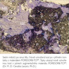 LASAK PORESORB®-TCP - náhrada kostného tkaniva