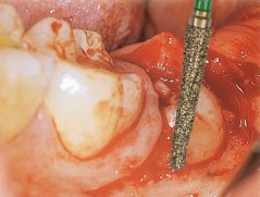 Edenta GSD1T - chirurgické diamantové nástroje, Osteotom - 3 ks