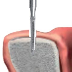 Edenta 186RF - chirurgické diamantové nástroje, Initial Bur - 5 ks