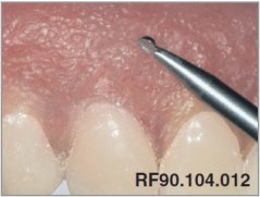 Edenta Lab RF90 - TC nástroje, Stippling Instrument - 5 ks