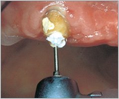 Edenta 178 - endodontické nástroje, Root Fillers typ "L" bez bezpečnostnej špirály - 4 ks